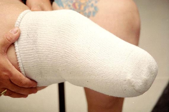 Stump Sock